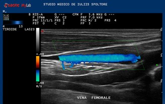 Eco Color Power Doppler Penieno Dinamico