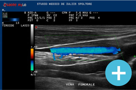 Eco Color Doppler