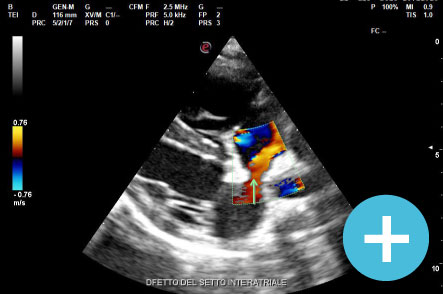 Ecocardiocolordoppler