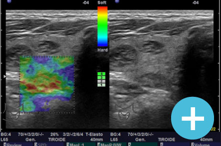 Elastosonografia